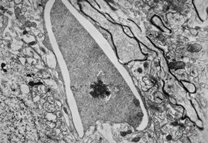 F,15y. | infantile neuroaxonal dystrophy (Seitelberger) F,15y. | infantile neuroaxonal dystrophy (Seitelberger)